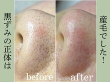 ティーツリー 名古屋 桜山(Tea Tree)/鼻のぶつぶつが黒く見える原因