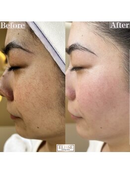 エリス(ELISSE)/くすみが気になる人にオススメ!