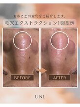 ユニ(uni.)/毛穴エクストラクション