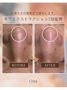 ユニ(uni.)/毛穴エクストラクション
