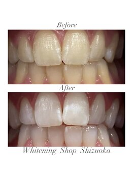 ホワイトニングショップ 静岡店/ホワイトニングBefore→After