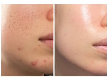 ラピュール(RaPur)/ハーブピーリング