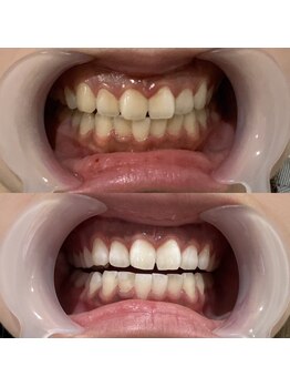 セルフ脱毛サロン SELFMADE イオンタウン仙台泉大沢店【3/29 NEW OPEN(予定)】 /ホワイトニングビフォーアフター