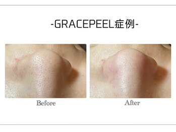 韓国肌管理・白玉肌管理 HOPE Retailer 安城店【3月OPEN(予定)】/施術写真