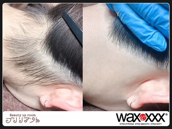 ブリリアント/うなじのwax脱毛