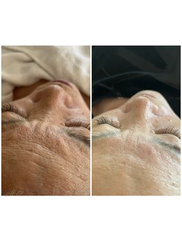 エム ビューティー(M Beauty)/セルラム　ビフォア＆アフター