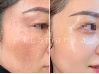 サロンドエテ(salon de ete)/プラズマニア症例