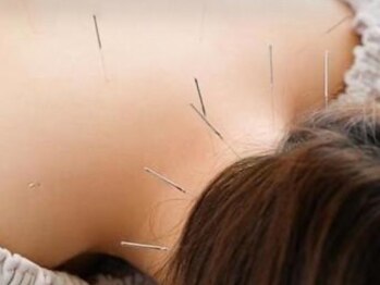 グレース鍼灸院 整骨院 ひたちなかの写真/【体の不調お任せください！】肩首こり/頭痛/浮腫み/眼精疲労/冷え性など身体の不調を【鍼灸施術】で改善★