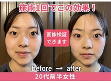 ドクターアーチ 神戸三宮 小顔矯正･整体サロン(Dr.ARCH)/画像検証★施術1回目の効果★