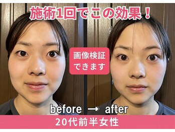ドクターアーチ 神戸三宮 小顔矯正･整体サロン(Dr.ARCH)/画像検証★施術1回目の効果★