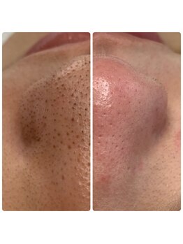 クワ(Cuwa)/毛穴/毛穴洗浄