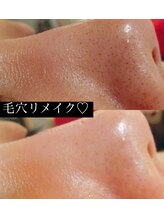マイン 幸店/毛穴リメイクフェイシャル★