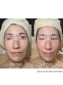 サロン ド ブラン アオヤマ(Salon de BLANC AOYAMA)/1番人気コース!before/after