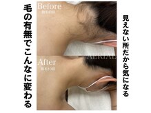 エアリアル 八代店の雰囲気（えりあし脱毛BeforeAfter）