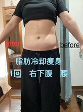 セルリアンブルー(Cerulean Blue)/2カップの施術結果です