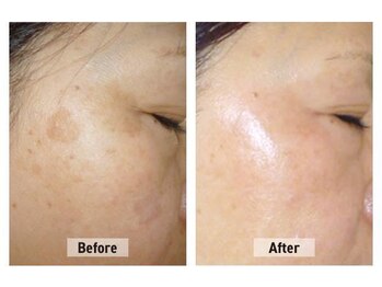 プレナ(PLENA)/本気シミケア改善!最後の切り札