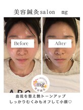 ミリグラム(mg)/【美容鍼灸６０分】