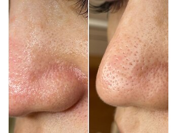 サイ(Sai)/気になるケア後の赤み