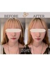チョコバリ 中目黒店(chocobari)/小顔×リフトアップ(美容鍼)20代