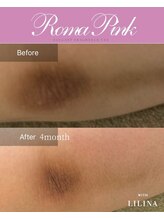 ウィズリリナ 新横浜(with Lilina.)/ローマピンク　症例　肘　ひじ