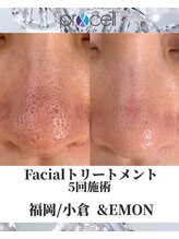 アンドエモン(&EMON)/【お顔】プロセル効果