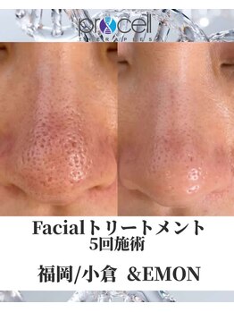 アンドエモン(&EMON)/【お顔】プロセル効果