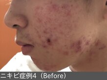 オアシスラグーン(OASIS LAGOON)/ニキビ改善（症例4 before）