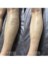 カナウ(KANAU)/脚脱毛（20代前半男性）