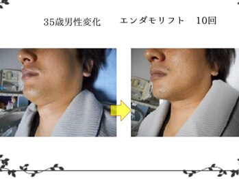 磨凛/エンダモリフト変化