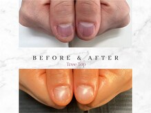 ツリートップ(Tree Top)/深爪矯正で自爪風仕上げ