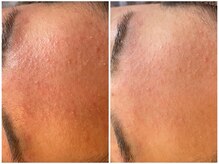 レスイズモア 恵比寿(less is more.)/1回の変化［ピーリングのみ］