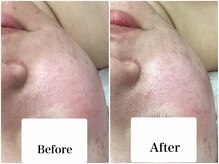 ルピア(L'pur)/むくみ、赤み改善！