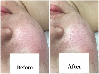 ルピア(L'pur)/むくみ、赤み改善！