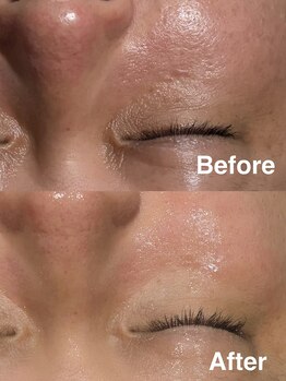 トライシフト 柏本店(TRY SHIFT)/メンズ_ハーブピーリング【柏】