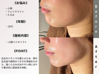 ルディラ 上野店/小顔バイオリフト