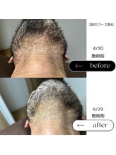 エスト(Est_.)/美容電気脱毛【デザイン髭】