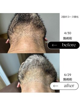 エスト(Est_.)/美容電気脱毛【デザイン髭】