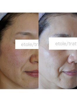 ザ シー タイムレスビューティ(THE SHE)/50代お客様症例写真