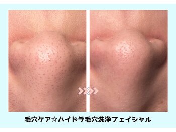バベルトータルビューティー 北堀江店(Babel Total Beauty)/ハイドラ毛穴洗浄コース￥3000