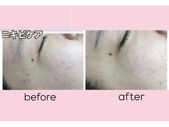 エステティック　レイビス 渋谷店(RAYVIS)/ハーブリバイブフェイシャル