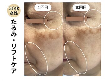 グラツィア(Grazia)/年齢肌に!リバースエイジコース