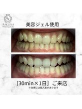ラクナ ホワイトニング(RAKUNA)/プロプラークホワイトニング症例