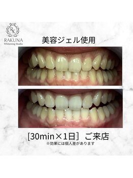 ラクナ ホワイトニング(RAKUNA)/プロプラークホワイトニング症例