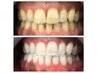 【お試し】通常ホワイトニング(ステイン除去)／1回照射
