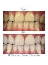 ホワイトニングショップ 静岡店/ホワイトニングBefore→After