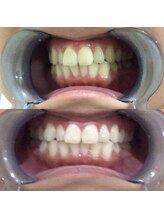 セルフ脱毛サロン　SELFMADE イオンタウン仙台泉大沢店【3/29 NEW OPEN（予定）】 /ホワイトニングビフォーアフター