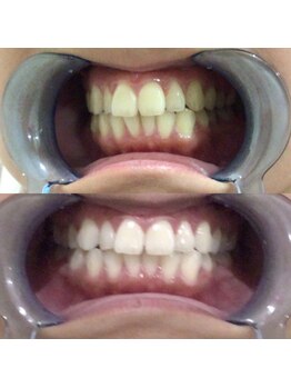 セルフ脱毛サロン SELFMADE イオンタウン仙台泉大沢店【3/29 NEW OPEN(予定)】 /ホワイトニングビフォーアフター