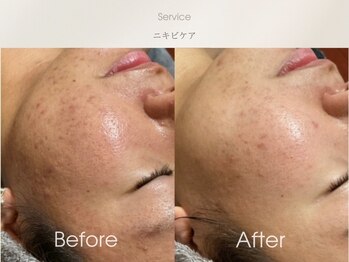 フェイシャルサロン ベルダ(BELDA)/【ニキビケアBefore After 】