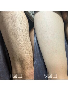 カナウ(KANAU)/脚脱毛（20代前半男性）