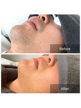 脱毛サロン メンズ 堂々/脱毛ビフォーアフター